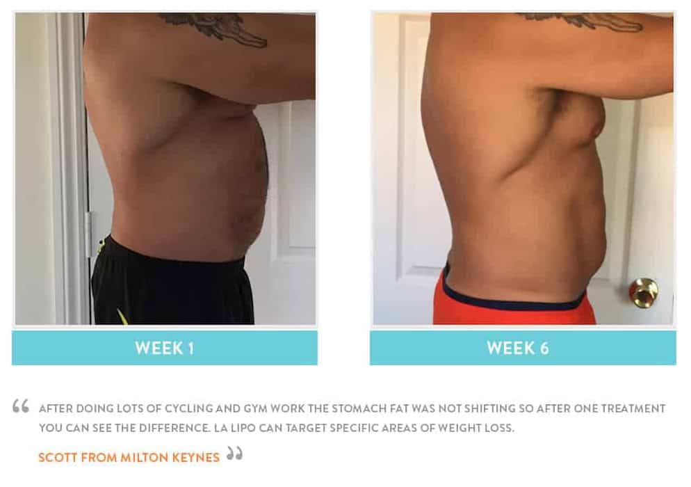 Before & After Stomach Fat Guildford