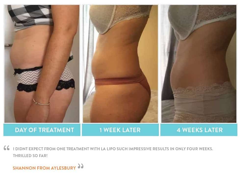 before, Cryolipolysis Guildford