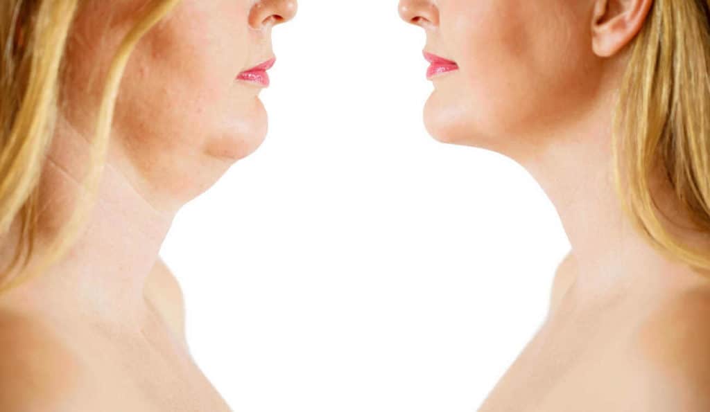 Double Chin treatment Guildford before and after results