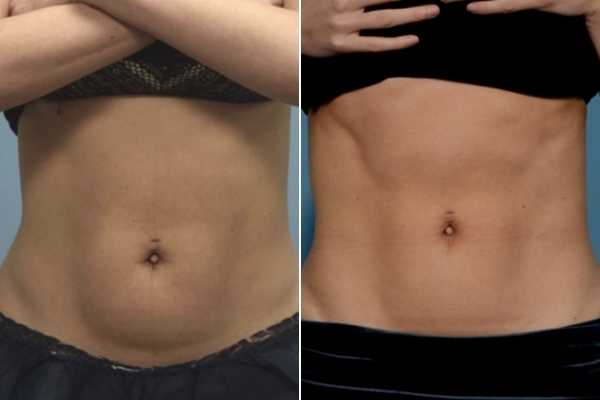 body sculpting FAQs Guildford