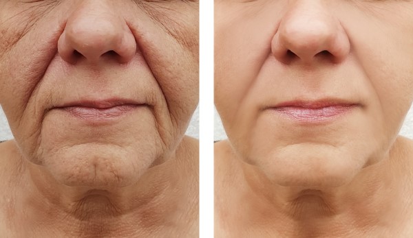 Learn more about Morpheus8 Treatment Guildford today!