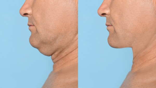 Which Non-Surgical Treatments Work Best for Jowls and Loose Skin Guildford?