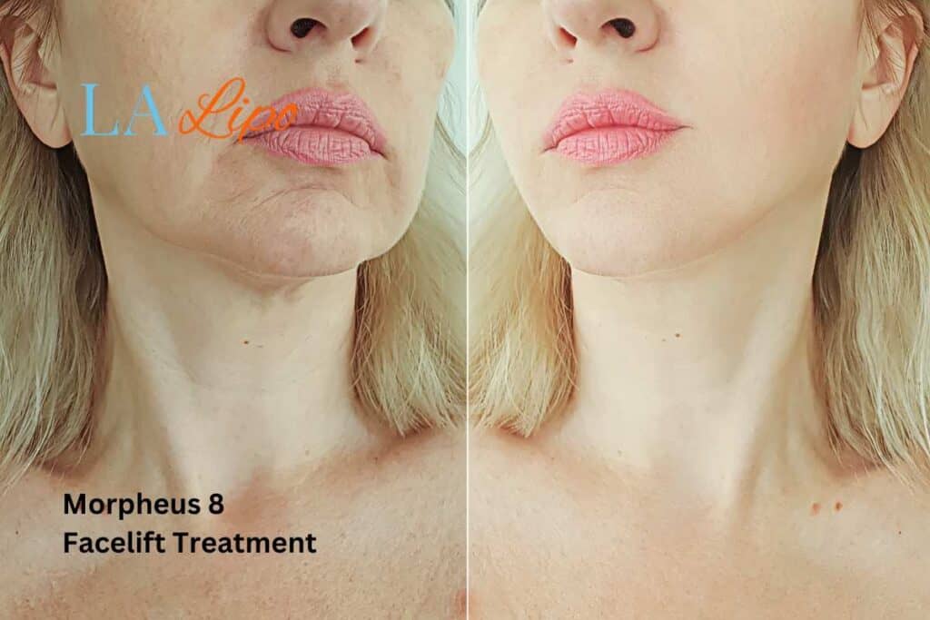 Turn back time with Morpheus8 Treatment Guildford