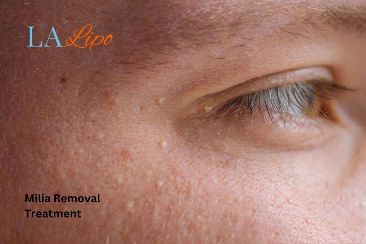 Cryopen Milia Removal: Is It the Easiest and Safest Option Guildford?