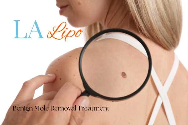 Why getting moles removed Guildford can boost your confidence!