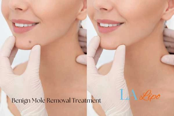 woman's before and after mole removal Guildford results