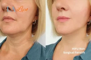 hi-fu for wrinkles Guildford before and after results