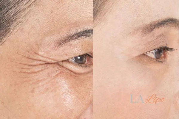 Before and after results of woman - HI-fu wrinkles reduction treatment Guildford