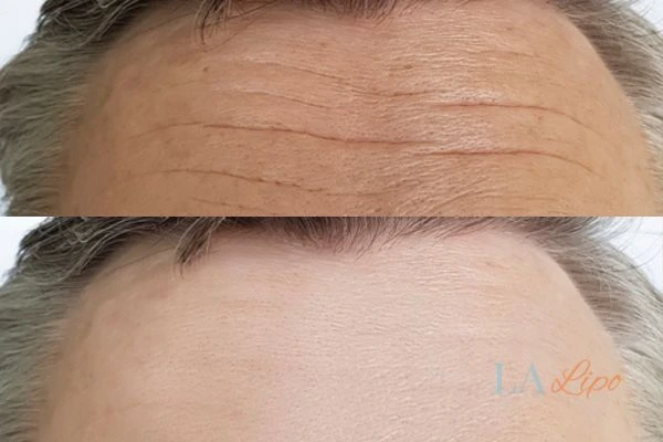 results of HIFU Guildford on mans forehead to help reduce lines and wrinkles