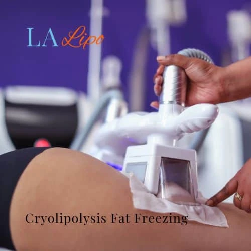 fat freezing - Cryolipolysis Guildford