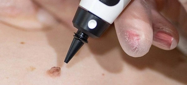 skin tag removal using cryopen Guildford