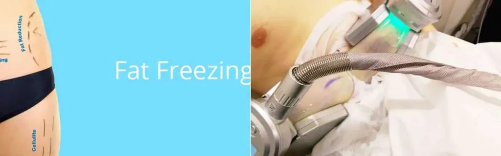 Fat freezing Guildford on multiple areas of the body