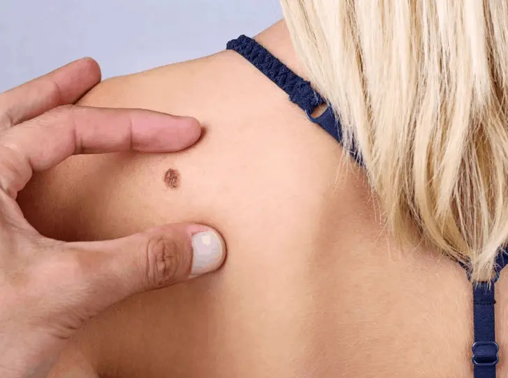 woman having mole removal Guildford consultation before treatment.