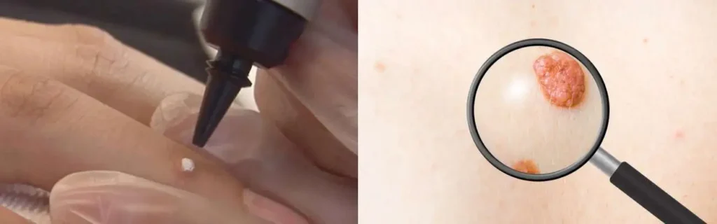 Cryopen for mole removal Guildford - speak to our team today!