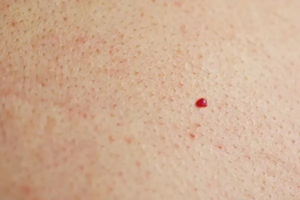 close up of a cherry angioma Guildford