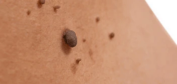 image of a skin tag Guildford
