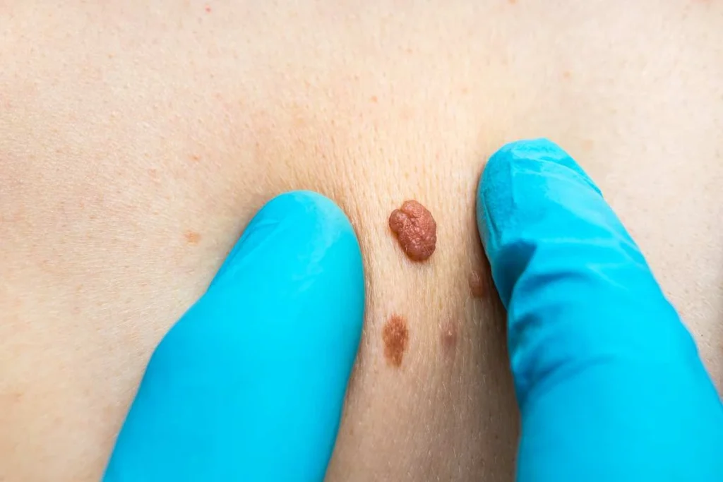Consultant examining a skin tag Guildford