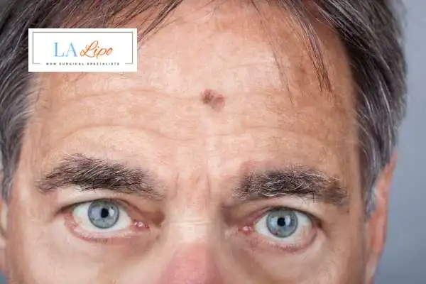 Solar Lentigo Removal Guildford image of man with mark on his forehead