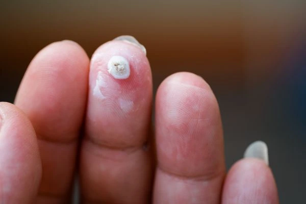 wart on person finger - cryotherapy to treat from LA LIPO Guildford