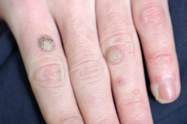 photo of warts on person hand - see wart removal Guildford from LA LIPO