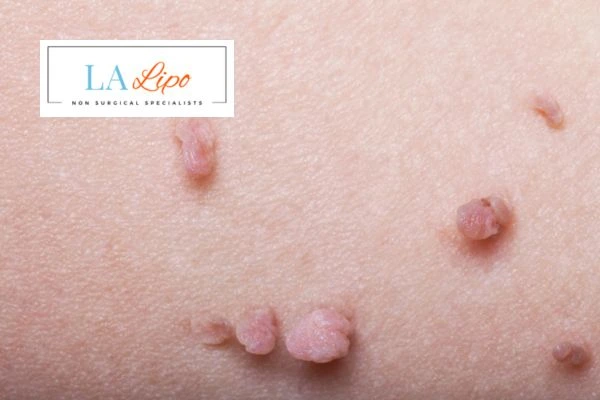 Does cryopen skin tag removal Guildford hurt? Find out now call our team today!