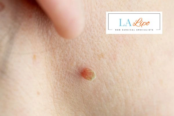 Book skin tag removal Guildford today speak to our team now!