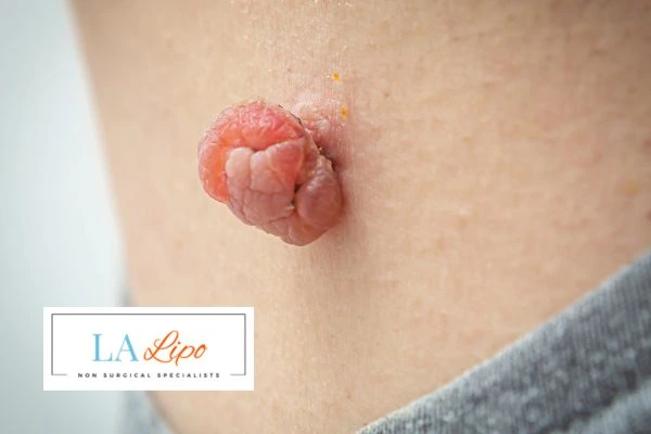Interested in skin tag removal Guildford? Concerned about the pain? Find out more today!