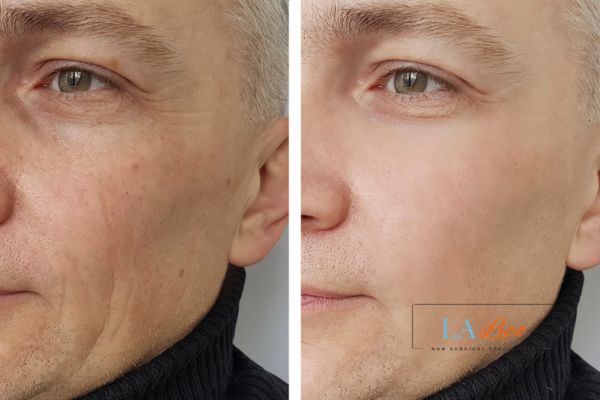 See the amazing results of Morpheus8 Treatment Guildford!