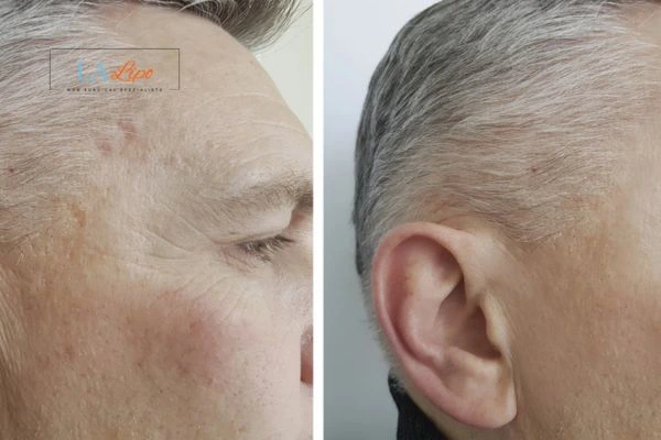 Mens Before & After Morpheus 8 Results Guildford