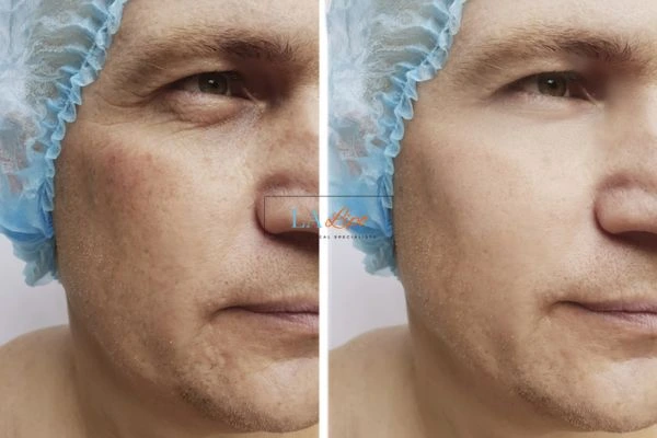 Before and after Morpheus 8 Results Guildford