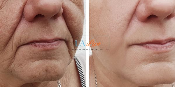 Older lady deeper wrinkle reduction - LA LIPO Morpheus 8 Results Guildford