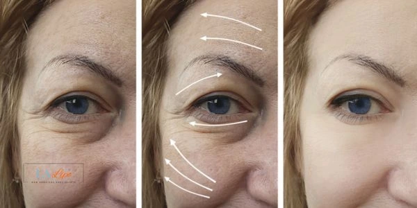 Amazing eye lift Morpheus 8 results Guildford