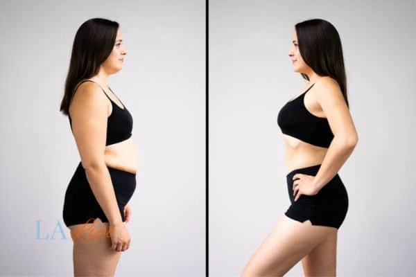 Picture of womans before and after using LA-EMS body sculpting to improve her core strength Guildford