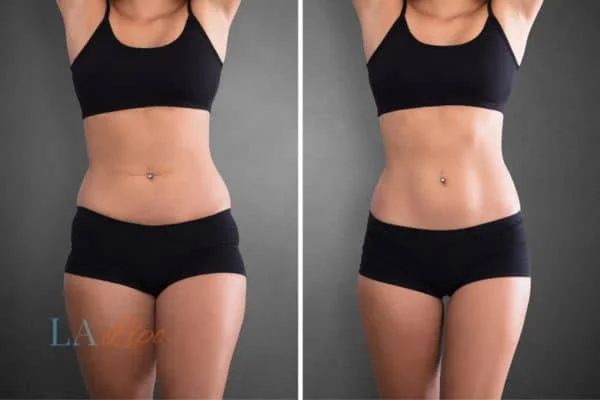 before and after results of non-surgical treatment to help a woman's body image and mental health Guildford