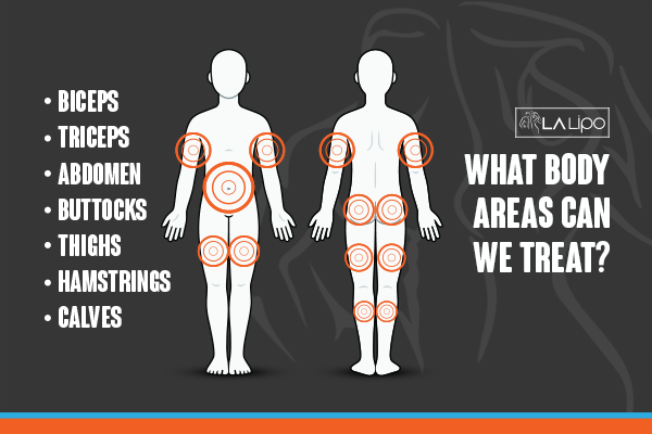 Diagram to show areas you can have LA-EMS Body Sculpting Treatment Guildford