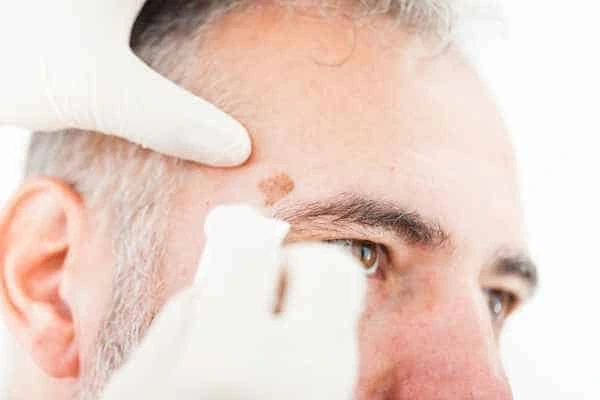Age spots and elderly people Guildford what is the link?