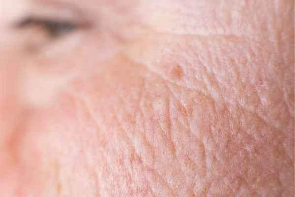close up picture of a woman's face showing an age spot Guildford