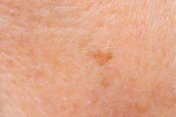 close up picture of age spots Guildford