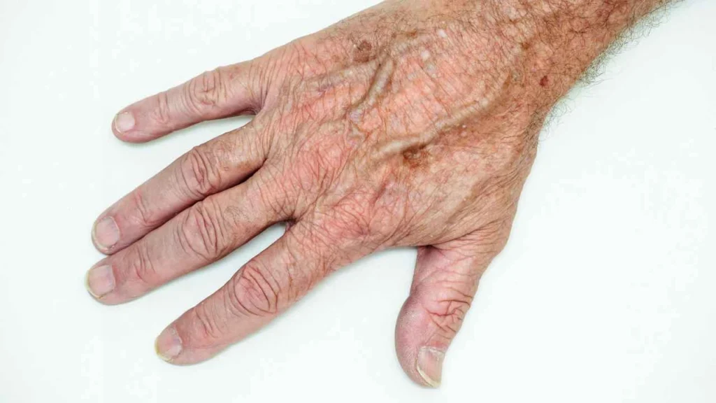 Male hand showing age spot Guildford