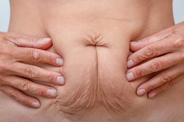 Image of a woman's stomach with loose skin - example of skin tightening Guildford options