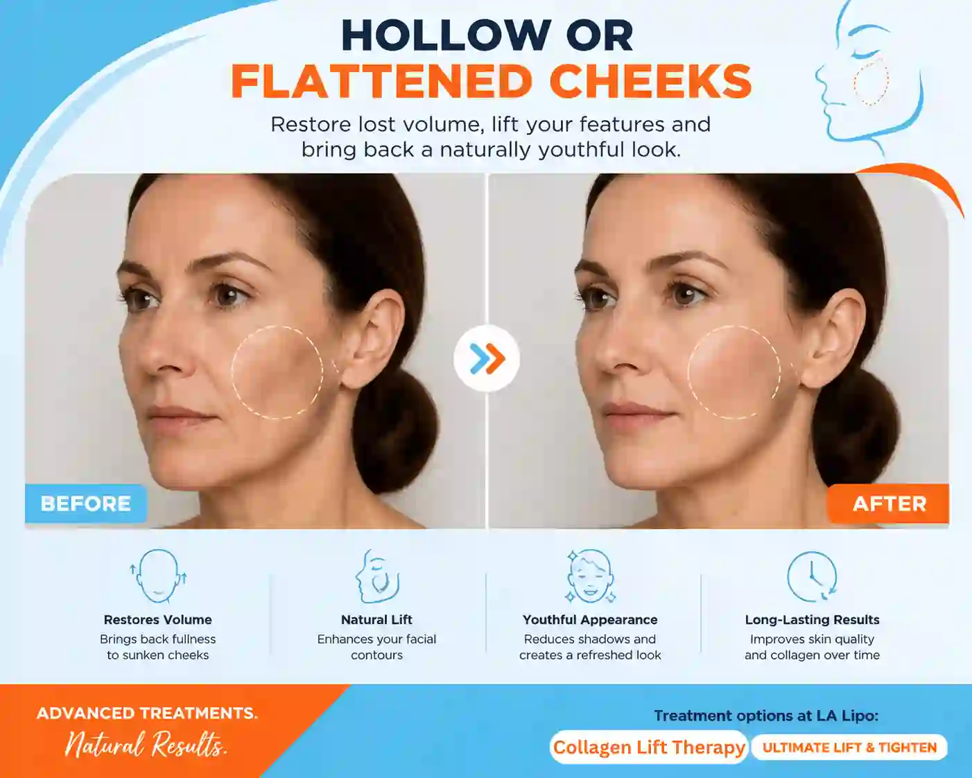 Sign #4: Hollow or Flattened Cheeks Guildford