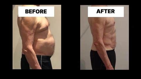What Symptoms Can Diastasis Recti Cause in Men? Weak Core, Back Pain and Poor Posture Guildford